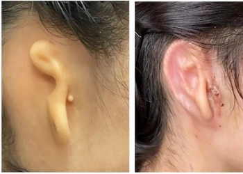 Cientistas usam tecnologia para fazer transplante de orelha 3D